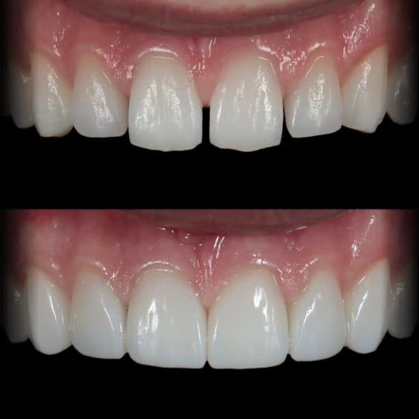 A midline diastema closed with composite bonding by Dr Albert Gajdos, before treatment