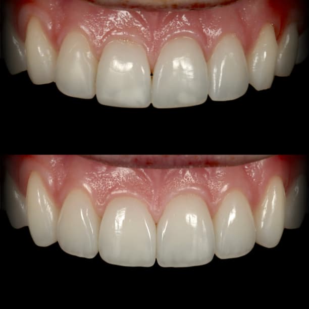 Composite veneers by Dr Albert Gajdos on uneven upper incisors with small spaces, before treatment