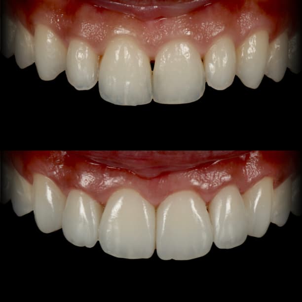Spacing between the upper front teeth closed with composite bonding by Dr Albert Gajdos, before treatment