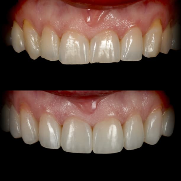 Composite veneers by Dr Albert Gajdos on worn, uneven incisal edges, before treatment