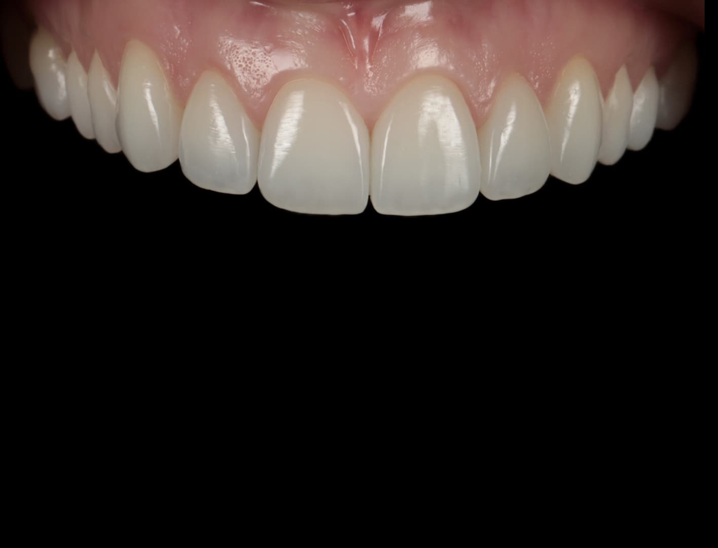 Upper anterior composite veneers: the single-shade result taught on the Simplifi Composite course